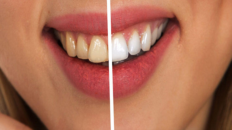 Wie werden Zähne aufgehellt?
