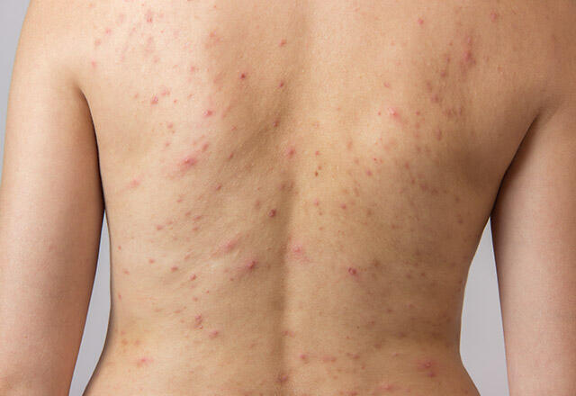 Hvorfor opstår acne på ryggen, hvordan passerer det? Guide til at slippe af med rygbumser!