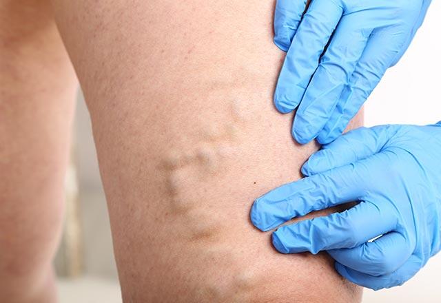 Ce cauzează vene varicoase și cum se tratează?