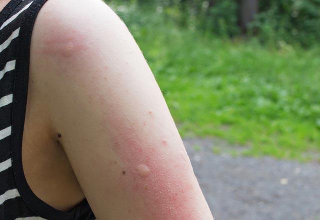 Cum trec mușcăturile de țânțari?