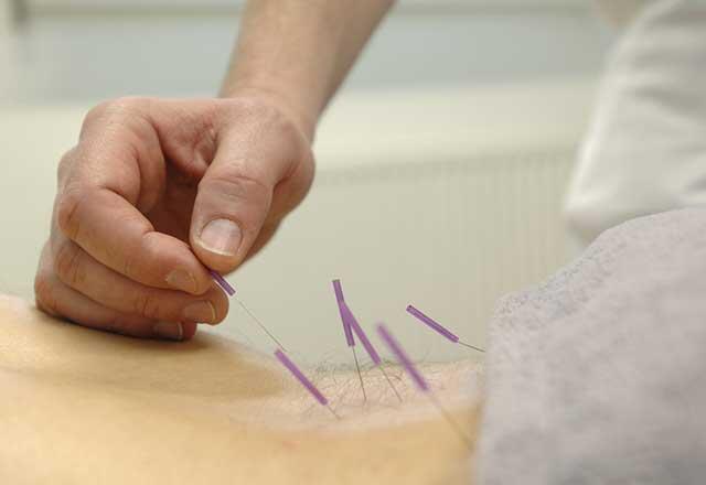 Mi az akupunktúra és hogyan történik?