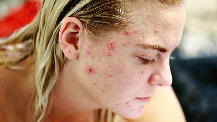 Comment traite-t-on l'acné kystique?