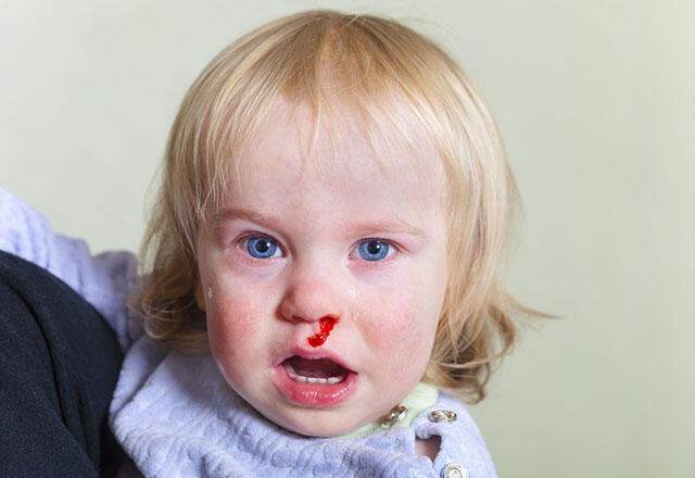 Warum blutet die Nase meines Kindes?