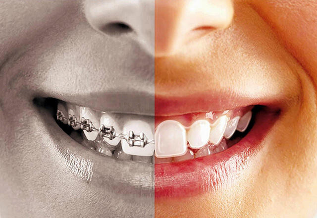 Zahnspange oder Invisalign-Behandlung?