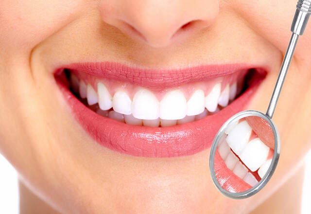 Kas yra dantų fanera?