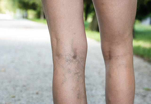 Ali so krčne žile na nogah nevarne?