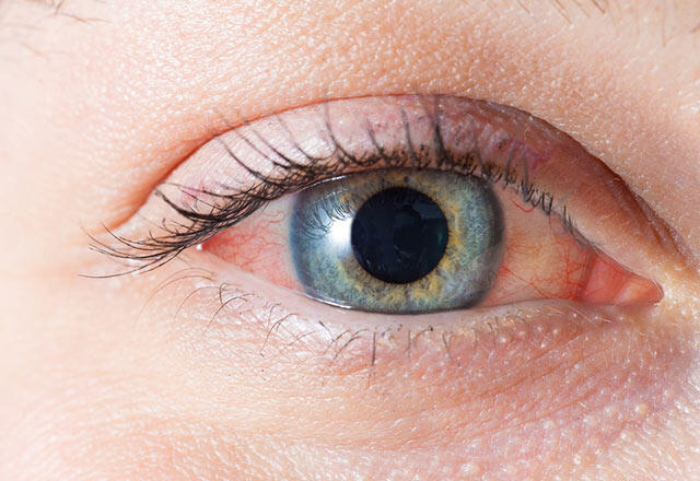 Øjenrødme kan være et tegn på sygdom