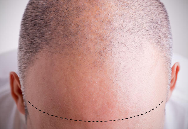 12 ting å vurdere etter hårtransplantasjon