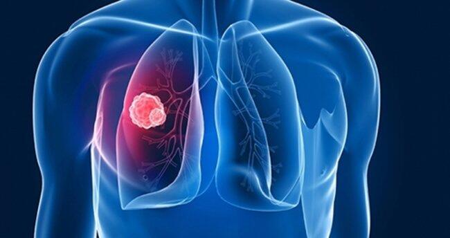 Šta je tuberkuloza i koji su njeni simptomi? Da li je TB bolest zarazna?