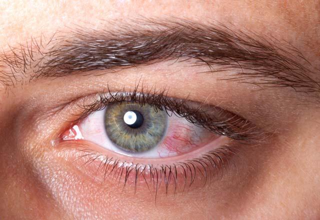 Wie kommt es zu Augenblutungen?