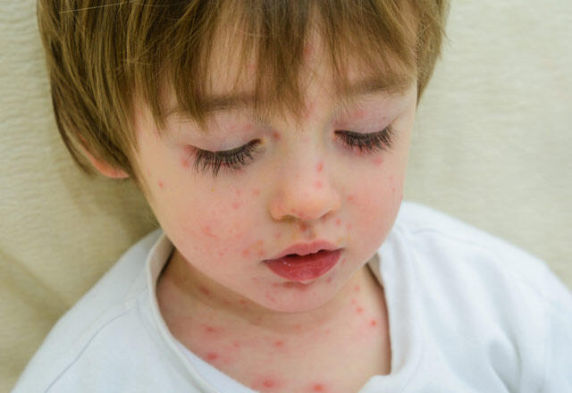 Care sunt simptomele varicelei? (tratament pentru varicela)