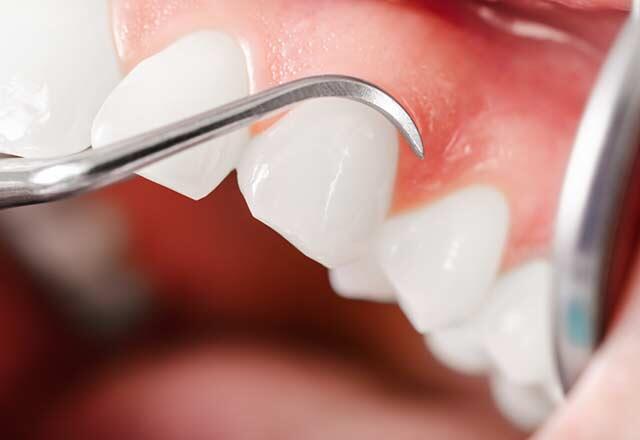 Diese Art von Krebs kann die Ursache für Zahnfleischerkrankungen sein.