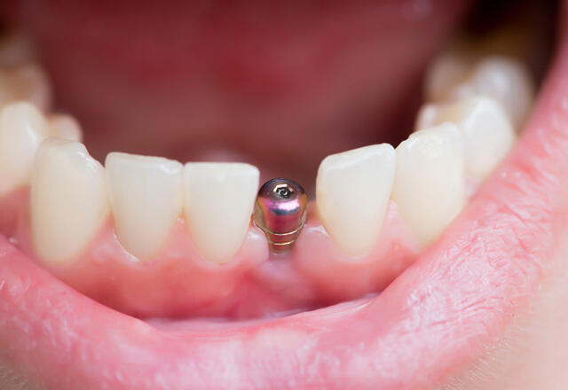 Ce este un dinte implantat?