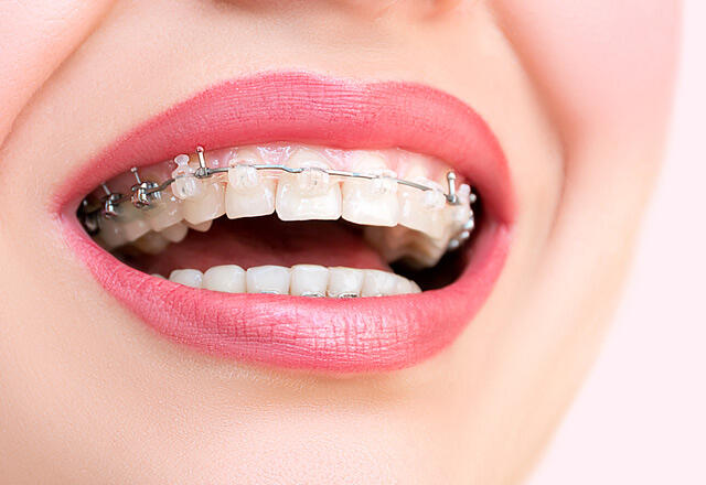 Was sind klare Zahnspangen?