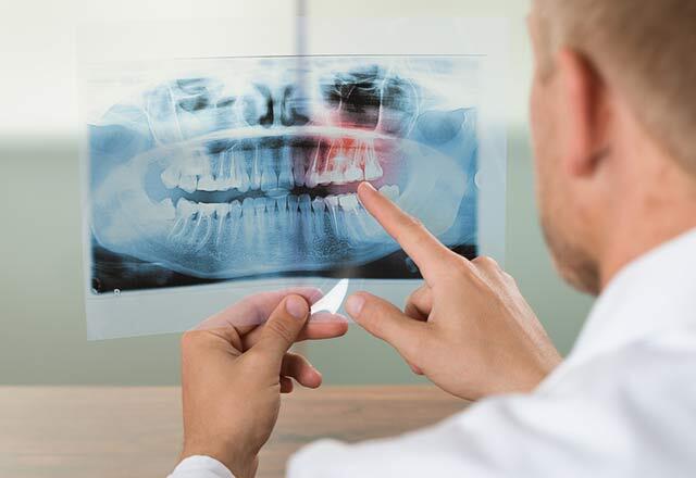 Ce cauzează topirea osului maxilar?