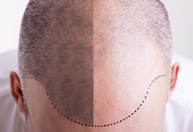 Kuo skiriasi DHi plaukų persodinimas ir FUE plaukų persodinimas?