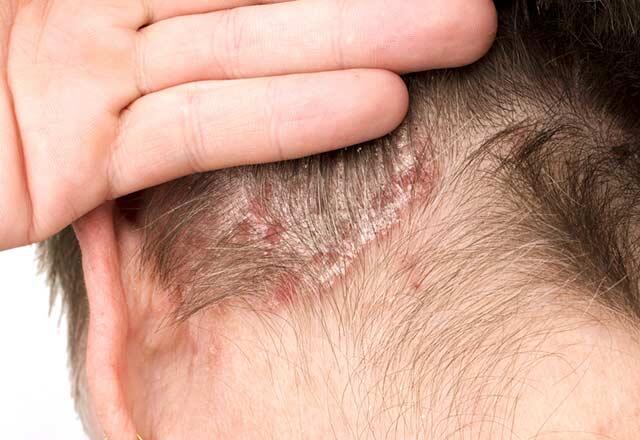 Kas izraisa garozas veidošanos uz galvas ādas?