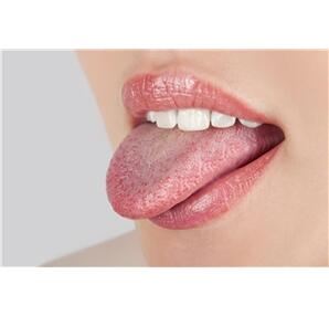 Herpes na jazyku (herpes)