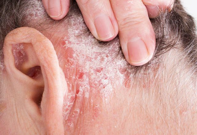 Scapa de eczema de pe scalp