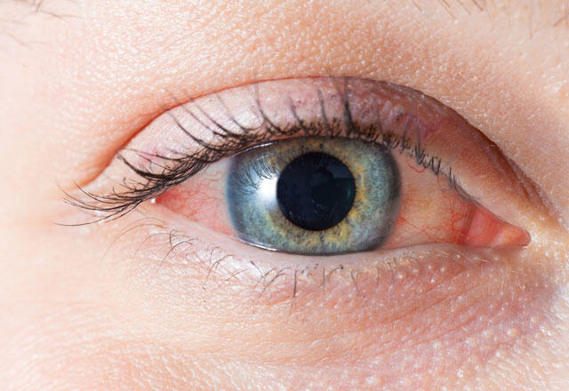 Aké sú príznaky svrbenia a začervenania oka?