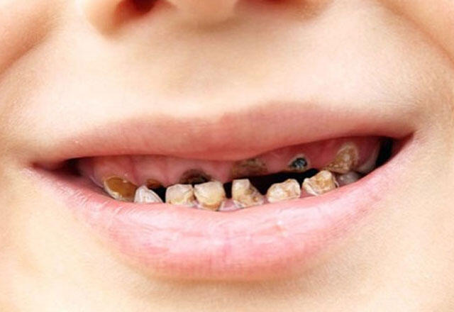 Zahnprobleme bei Babys und Kindern