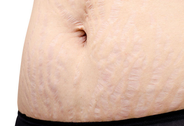 Wie verlaufen Schwangerschaftsstreifen und Hautunreinheiten?