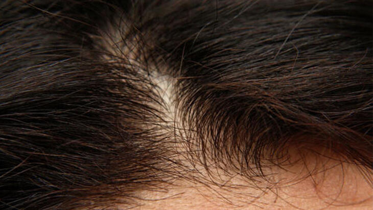 Kako prolazi perut? Što je dobro za kosu protiv peruti? Koji su prirodni načini da se riješite peruti?