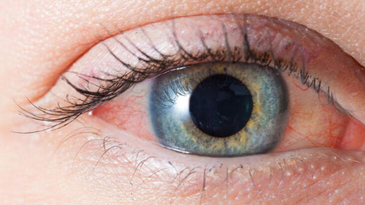 Vzroki za solzenje oči, kaj so vzroki? Kaj je dobro za solze? zeliščno zdravljenje vodenih oči