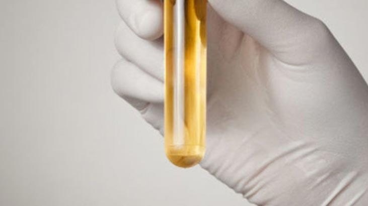 Hvad er urinepitel? Hvor mange epitel skal der være i urinen? Årsager til højde og lav
