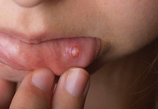 Simptome necunoscute ale cancerului gurii