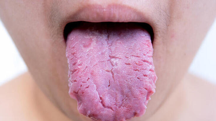 מה גורם לפצעים בלשון? כיצד מרפא פצע בלשון? - טיפולי פצעי לשון