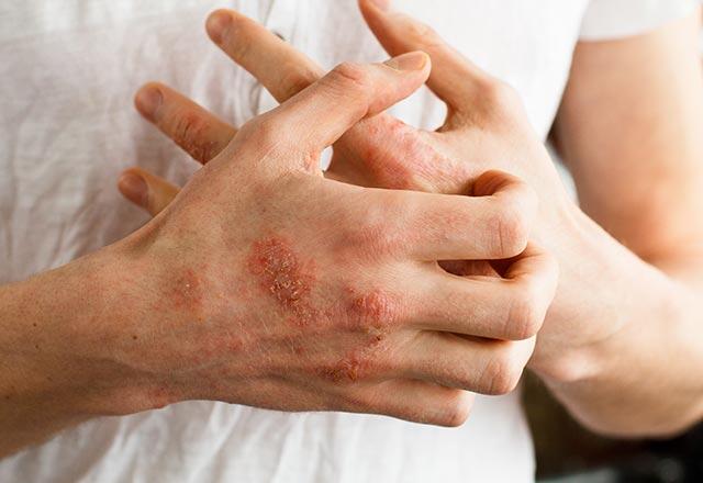 Ce cauzează eczema?
