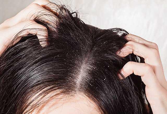 Cum dispare mâncărimea scalpului?